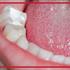 دلیل اصلی پانسمان دندان عصب کشی شده چیست؟